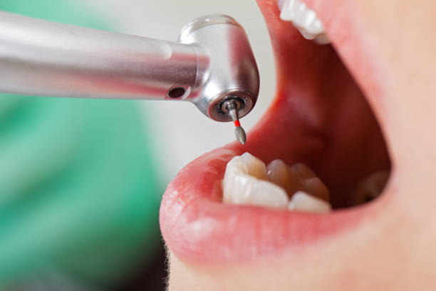 Best Emergency Wisdom Teeth Removal in Delta, OH